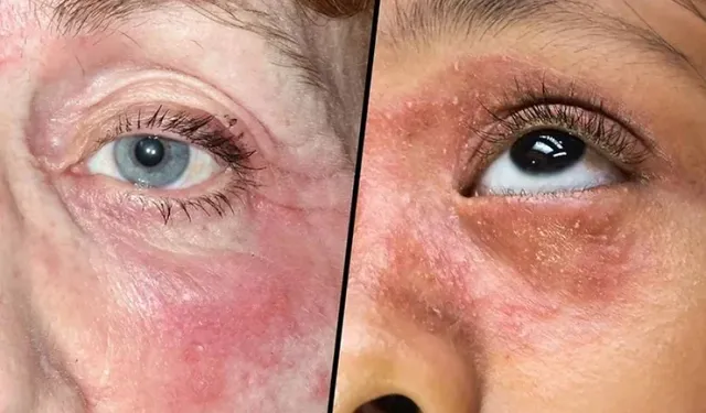 Yüzünüzdeki Egzamayı Nasıl Yönetebilirsiniz?