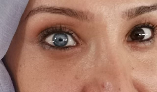 GÖZLERİNİN BİRİ MAVİ, DİĞERİ KAHVERENGİĞ OLARAK DÜNYAYA GELDİ